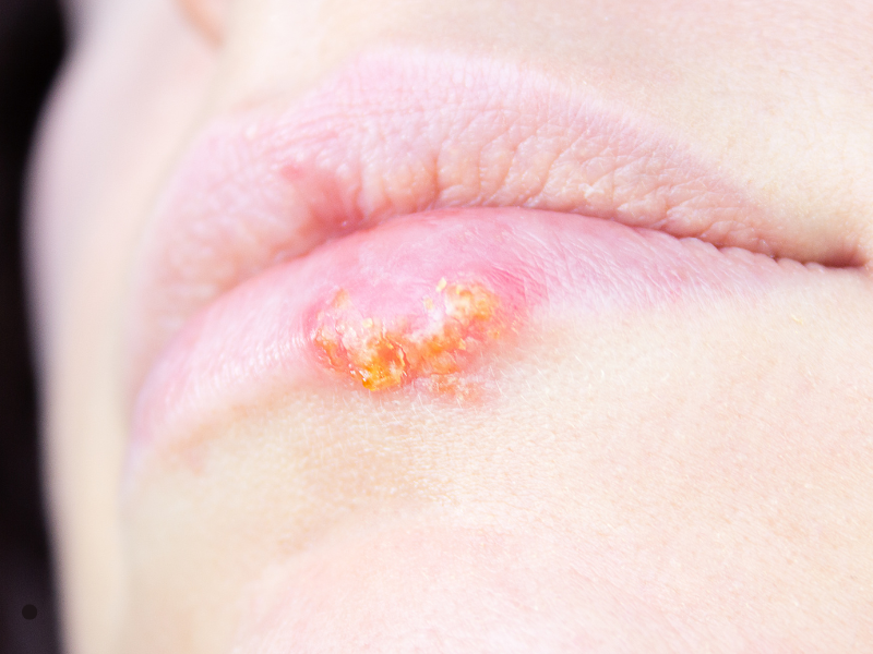 Herpes Bucal